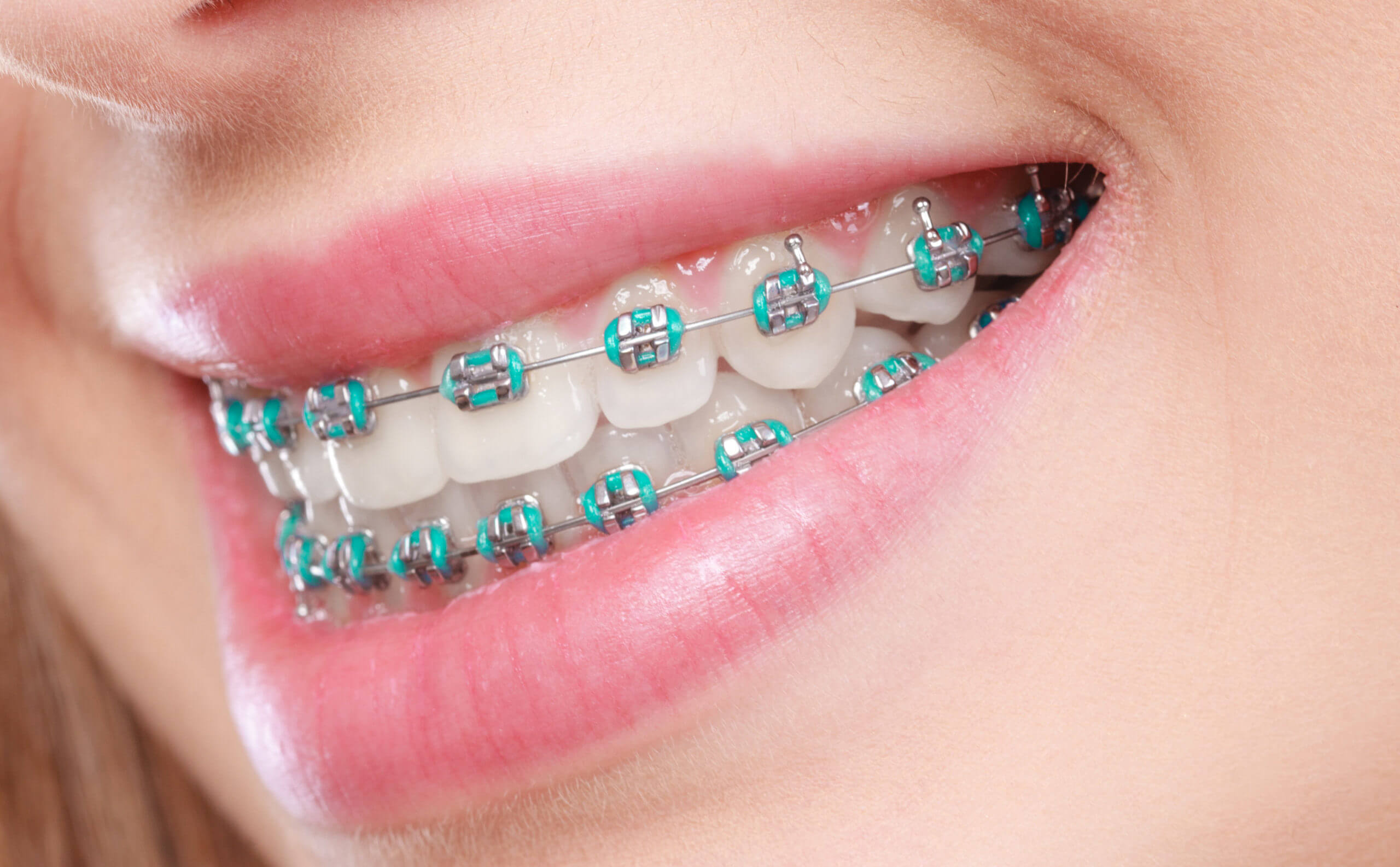 Rubber bands for braces scaled 1 how general dentistry prepares teeth for successful cosmetic outcomes' edge.