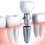 4 ways technology improves the look of dental implant restorations