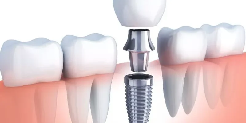 4 Ways Technology Improves The Look Of Dental Implant Restorations