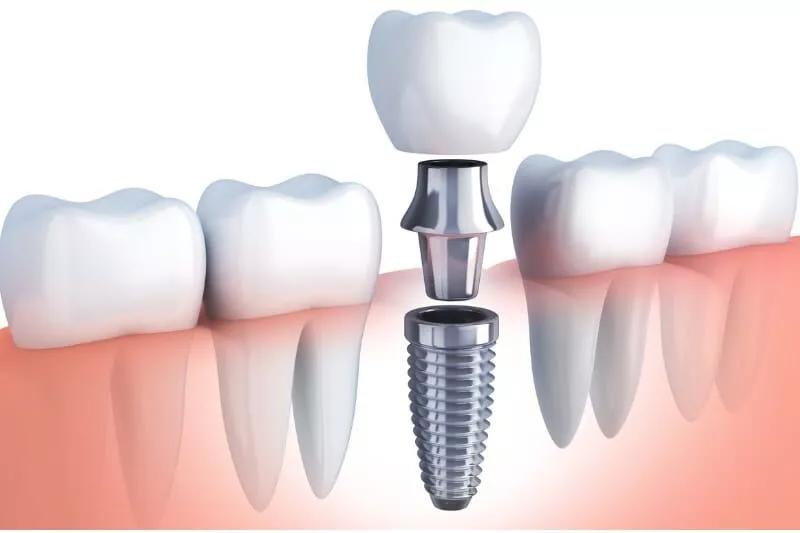 how technology is changing the future of implant dentistry